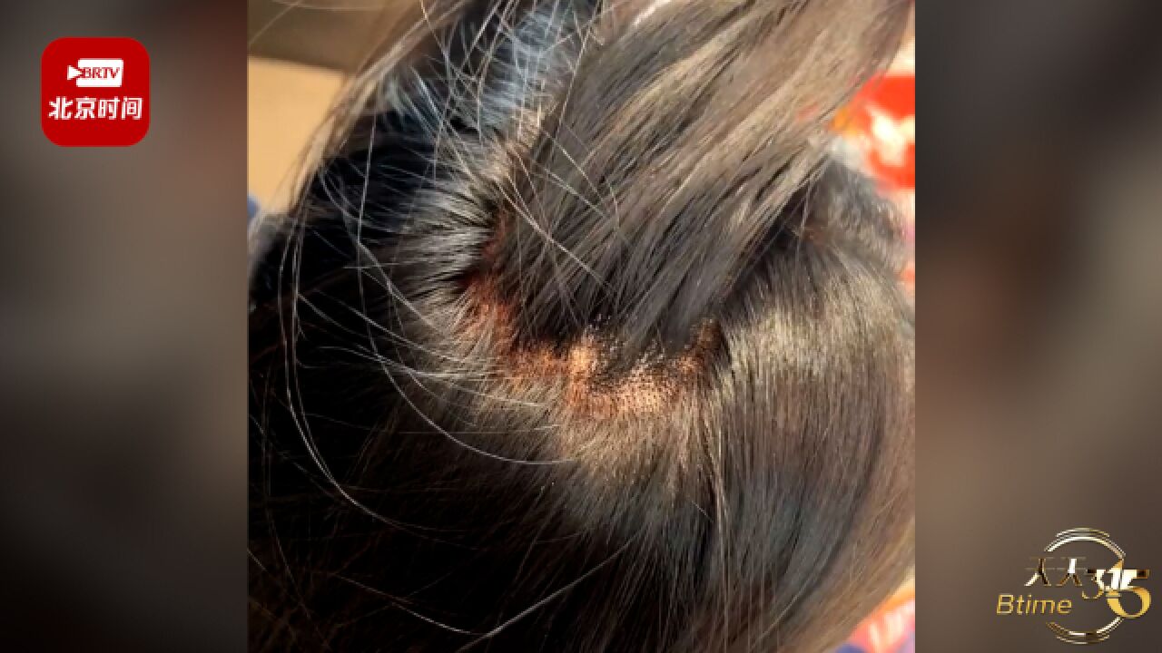 天津一女子染发后头皮二度烧伤 理发店:以前也出现过,个人体质问题