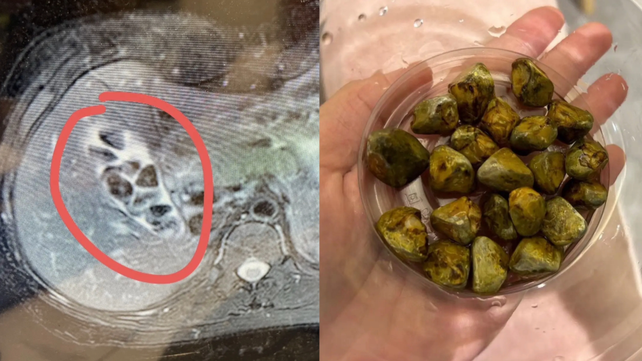 乐观女子盘24颗胆结石,被送称号"炼丹炉女士",竟有人私信求购