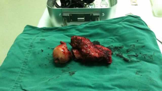 医生失手切掉3岁男童丁丁悄悄用绷带做个假的蒙混