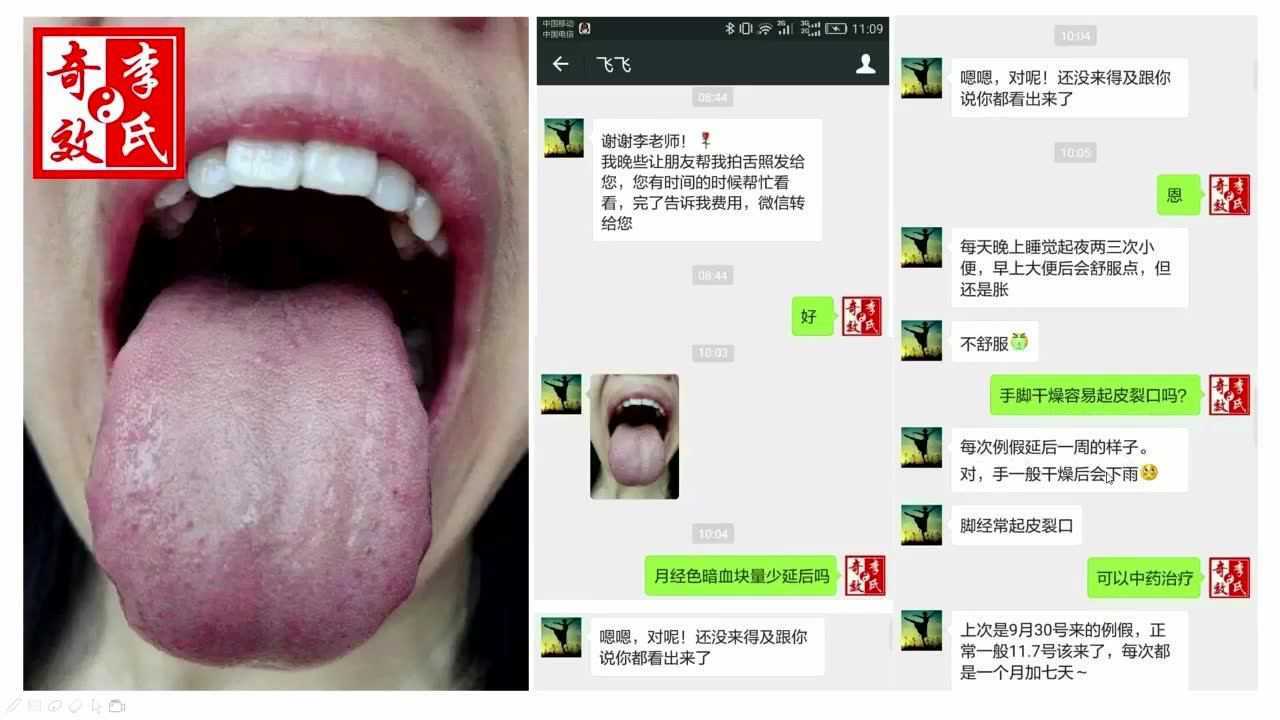 12舌诊综合案例解析下李芳祥奇效舌诊2017版