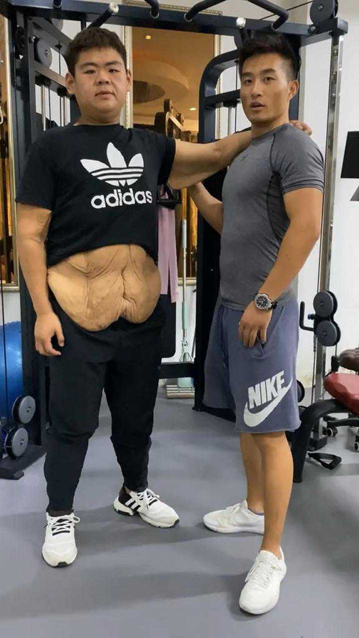 曾经688斤一年时间瘦下来300多斤肚子竟然成了这样