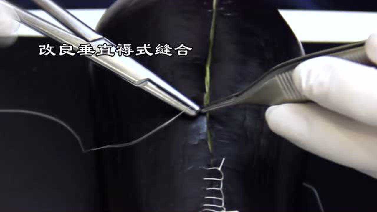 改良垂直褥式缝合