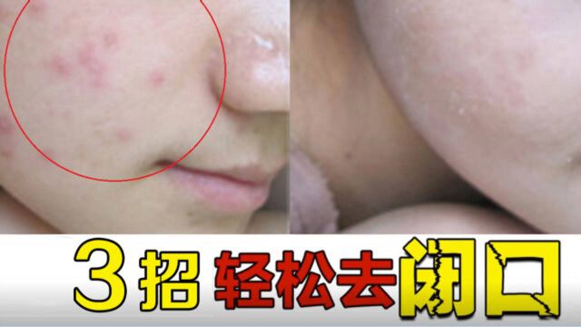 粉刺怎么去除小妙招,脸上长痘痘怎么消除,怎样去除闭口粉刺小妙招