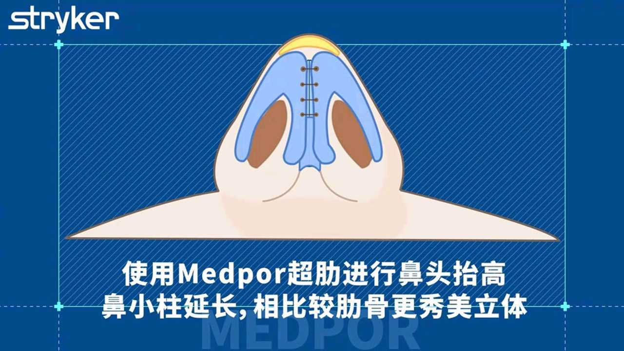 曼特波超肋隆鼻22支架方案进行鼻头抬高鼻小柱延长相比较肋骨更秀美