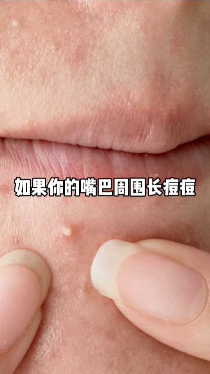 如果你的嘴巴周围长痘痘可能是这里出现了问题