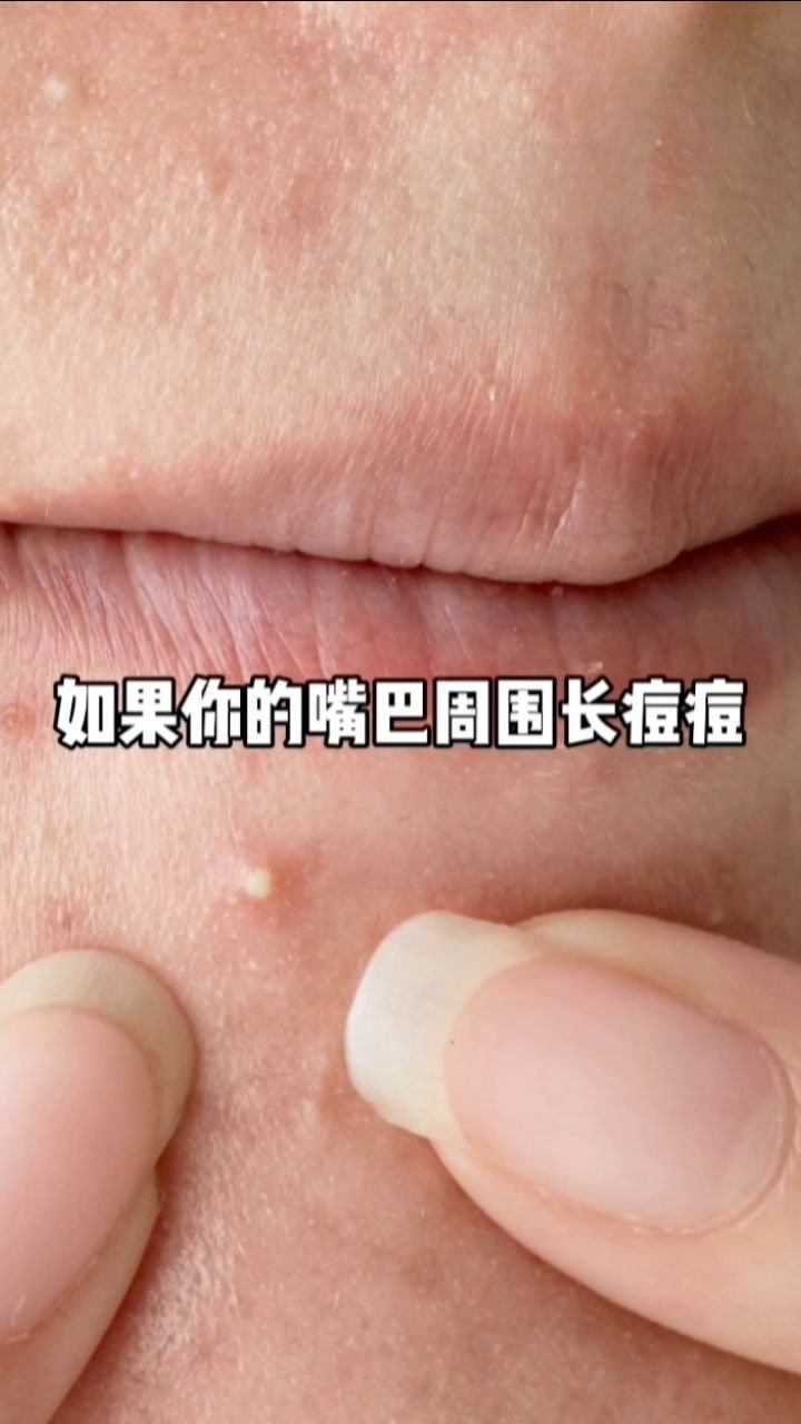 如果你的嘴巴周圍長痘痘可能是這裡出現了問題