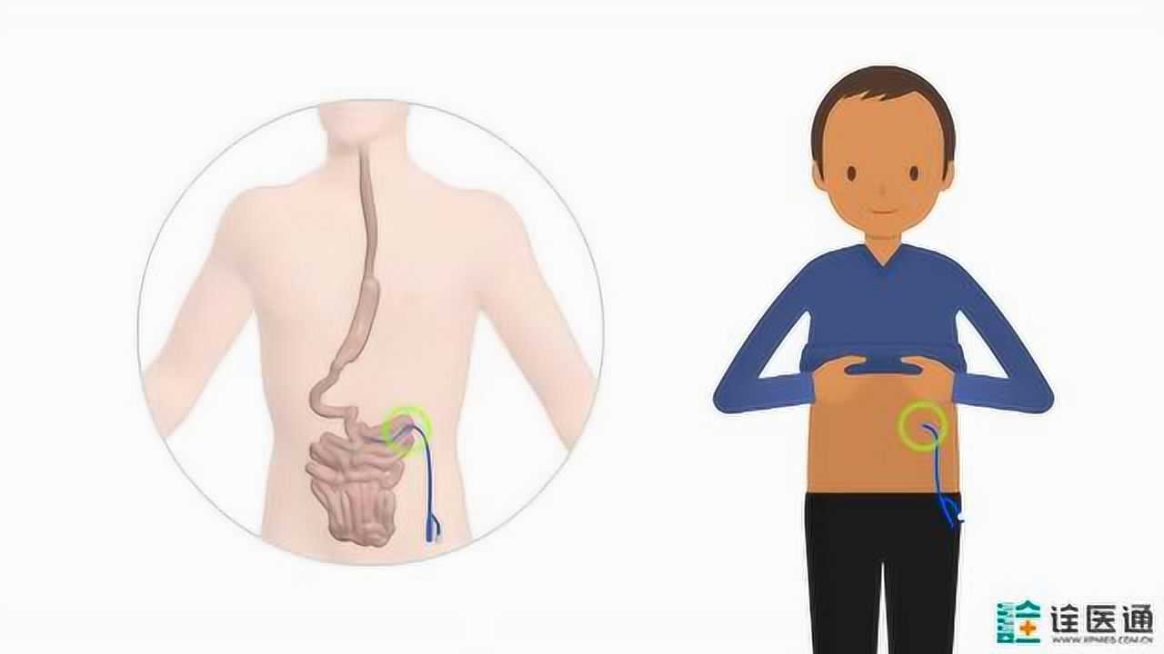 如何护理空肠造瘘管?