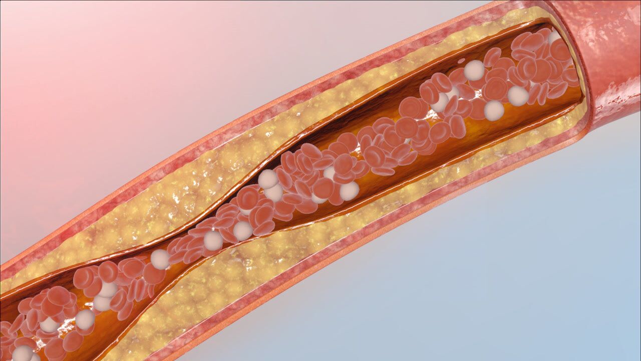 血管堵塞对人体的危害!堵塞位置不同,引发疾病不同,这里最严重