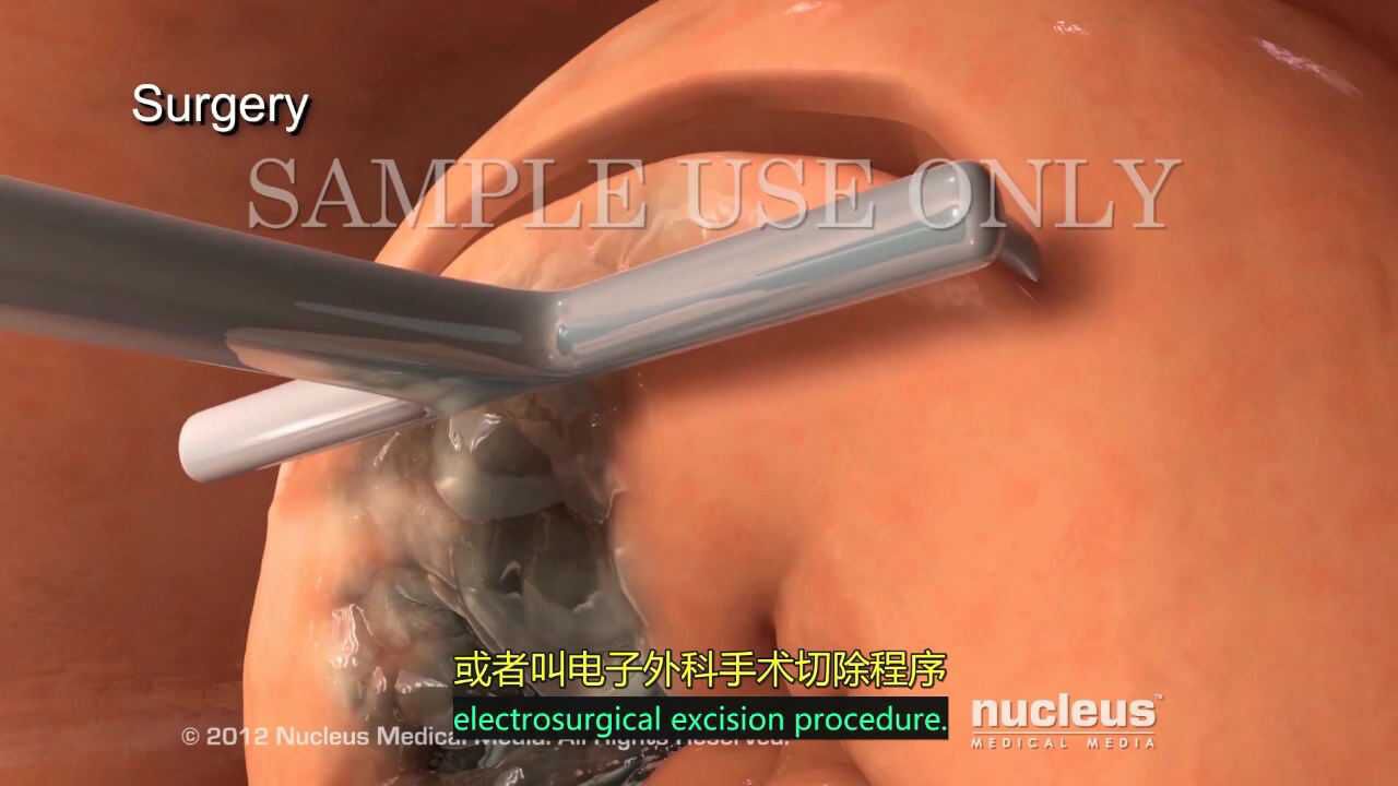 3D医学动画，宫颈癌治疗方案_高清