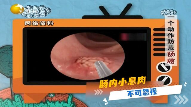 健康朋友圈:肠内小息肉,不可忽视