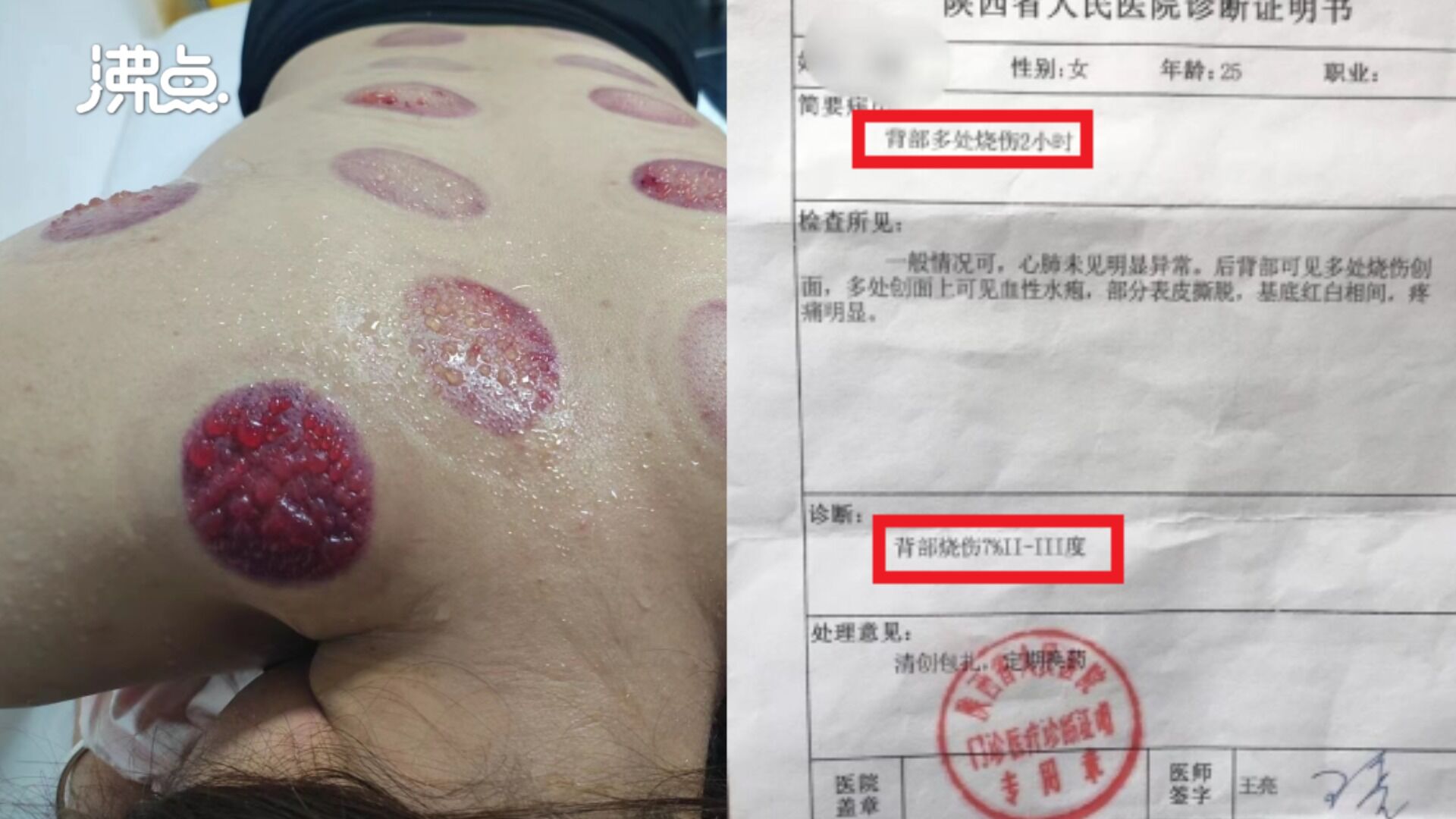技师着急下班女子拔罐后背烫出大片血泡当事人三级烫伤店家让体谅技师