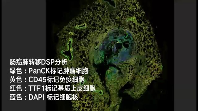 DSP肠癌肺转移2160321原始数据(带字幕)