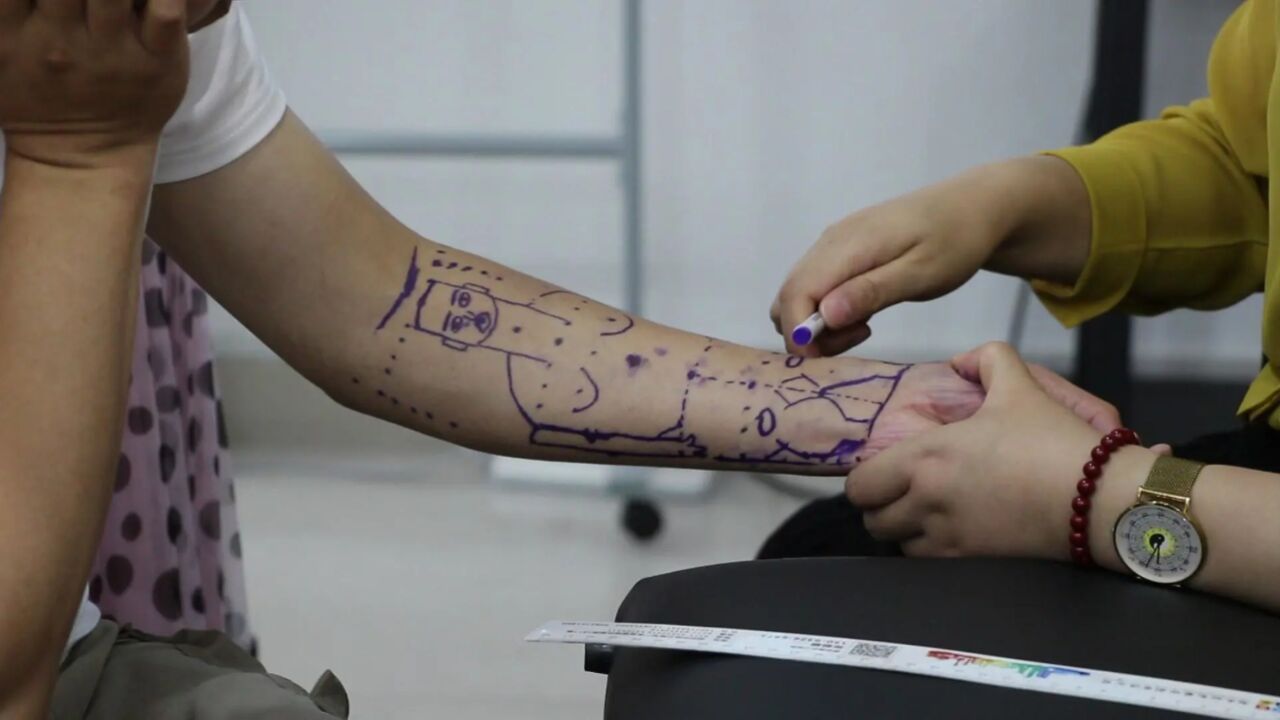 陈氏臂针全息疗法