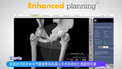 淮海经济区首台关节置换骨科机器人手术在徐州仁慈医院开展