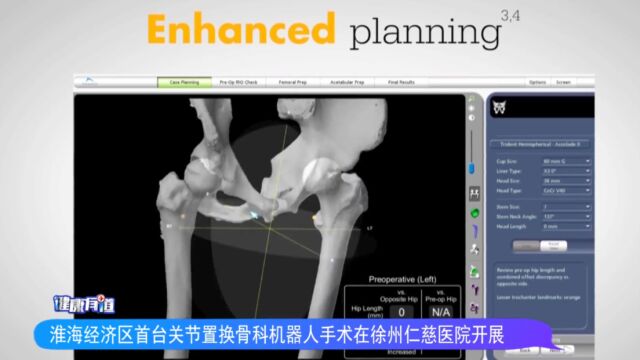 淮海经济区首台关节置换骨科机器人手术在徐州仁慈医院开展