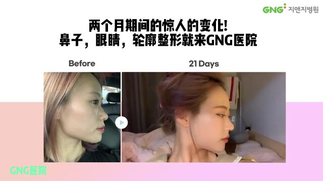 知名Tik Tok博主曝光自己的变美秘诀——原来竟是在韩国GNG做了轮廓+眼鼻手术𐟘