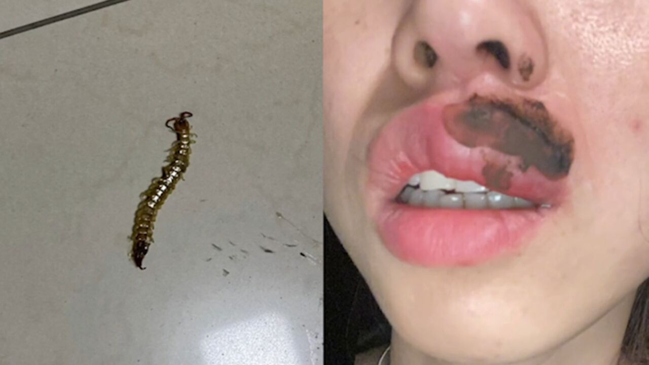 女子熟睡中被蜈蚣咬醒肿成香肠嘴,当事人:疼痛感很强烈
