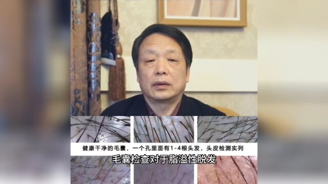 发密密毛发中心:脂溢性脱发为什么要做毛囊检测?