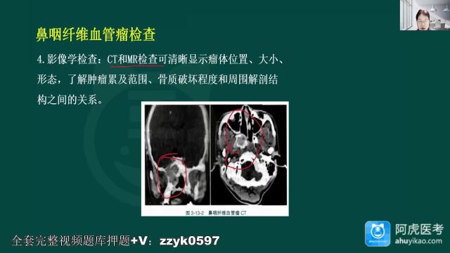  2024年阿虎医考耳鼻喉(头颈外科)副高主任医师试视频题库历年真题培训鼻咽纤维血管瘤 tyh