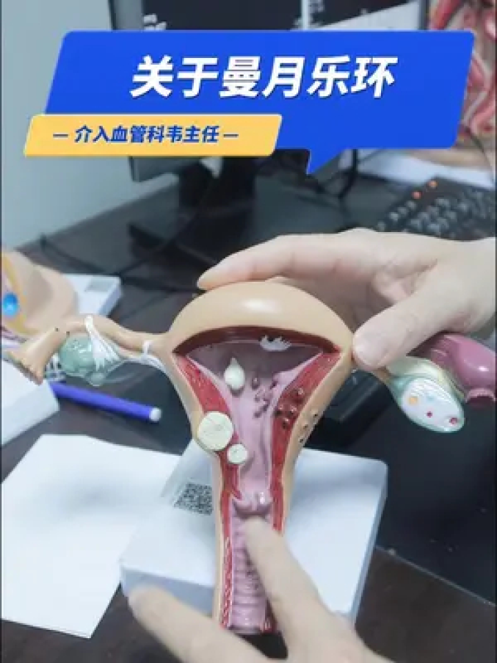 曼月乐环 #曼月乐环 #曼月乐环脱落 #子宫疾病 #介入医生的日常