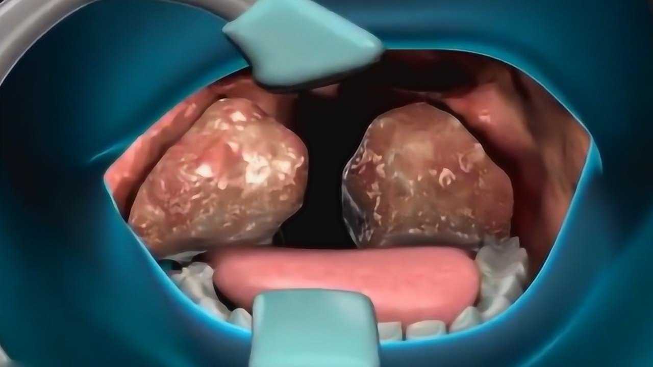 扁桃体是如何切除的？3D动画演示手术过程_高清