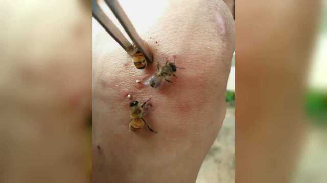 这人是怎么了怎么还拿蜜蜂蜇自己啊