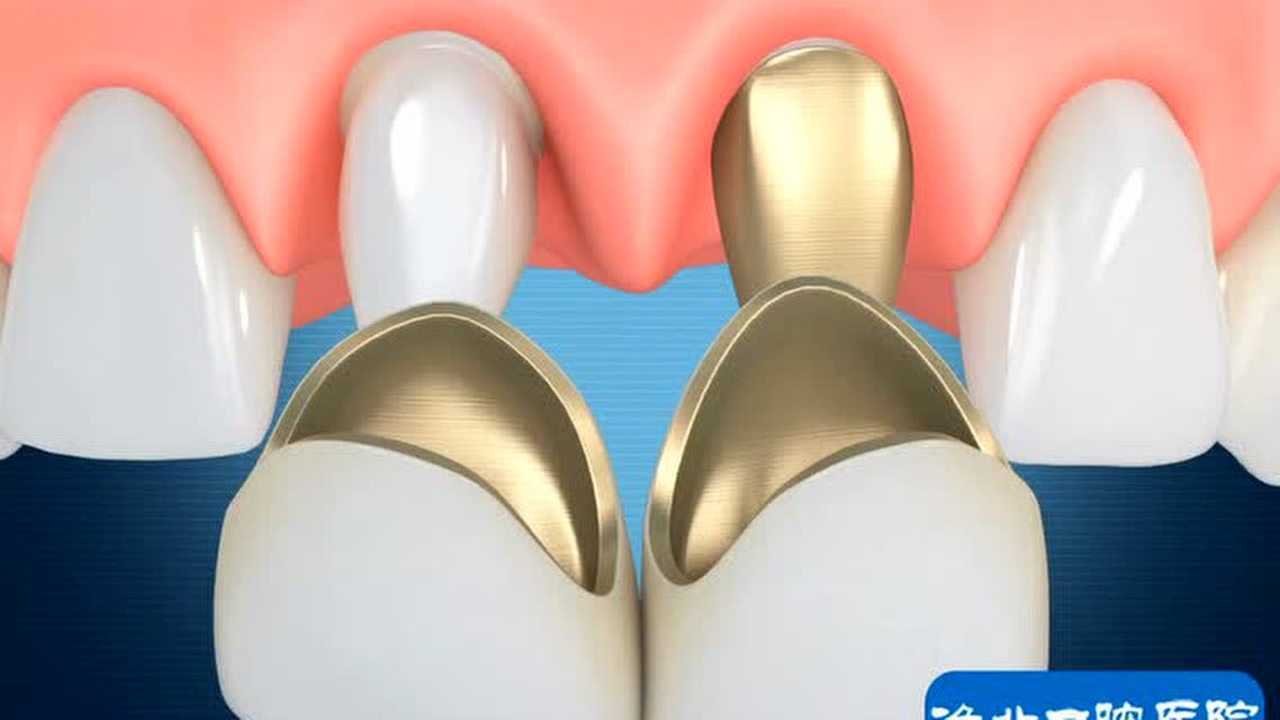 牙体牙髓治疗桩核金属桩