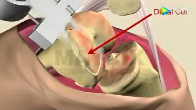 3D演示接骨手术,真是厉害了