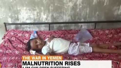 也门 饥饿儿童 触目惊心