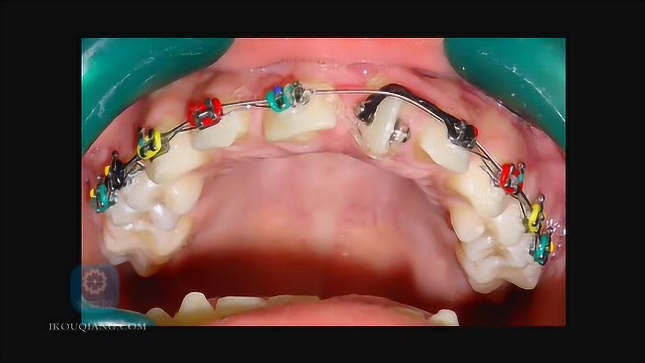 就是这么神奇,门牙扭转牙齿矫正
