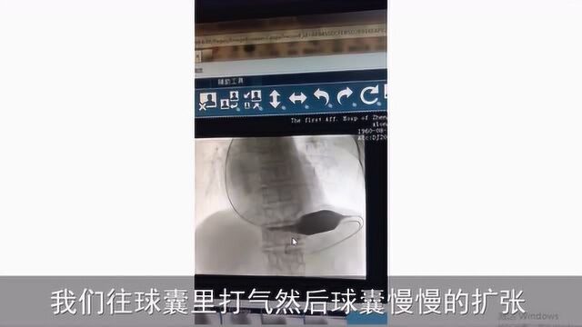 食道反流和胃食管反流有区别吗为什么医生只坚持用球囊扩张术治疗