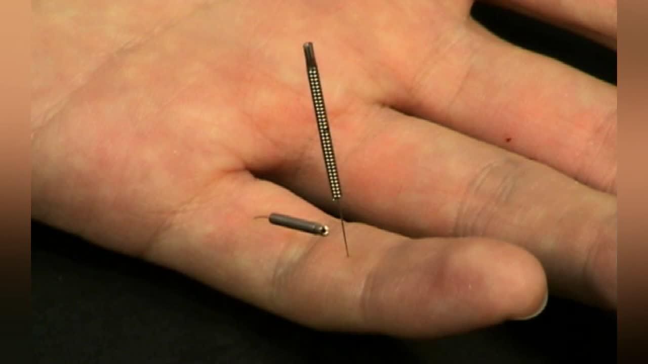 董氏奇穴针灸太阳穴之太阳一穴太阳二穴视频一一手指部位董针