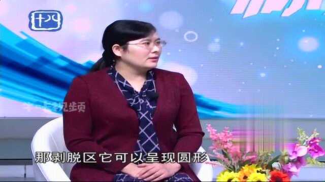 口腔小常识:地图舌红斑和位置会不断变化,因此也叫游走性舌炎