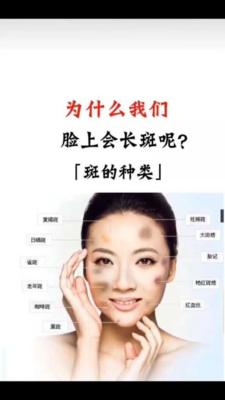 斑的种类有哪些,为什么我们脸上会长斑呢?