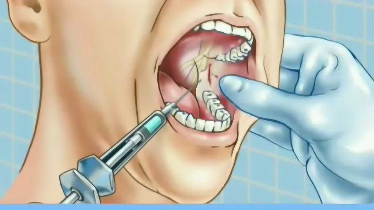 往口腔里打麻药3d动画全过程,看着就特别的疼,一定要爱护好自己的牙齿