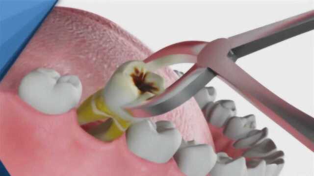 蛀牙被拔出的那一瞬间,究竟有多疼?隔着屏幕都觉得紧张!