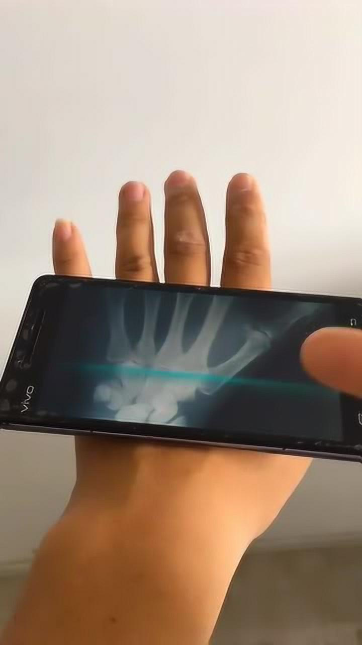 手机x光透视扫描再也不用去检查了