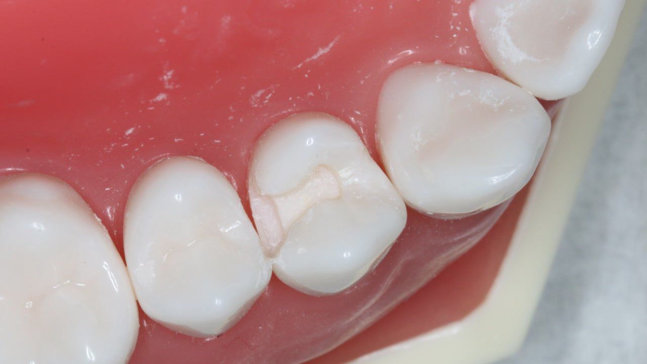 24仿真牙ii类洞制备-牙体牙髓病学实验4-3_腾讯视频