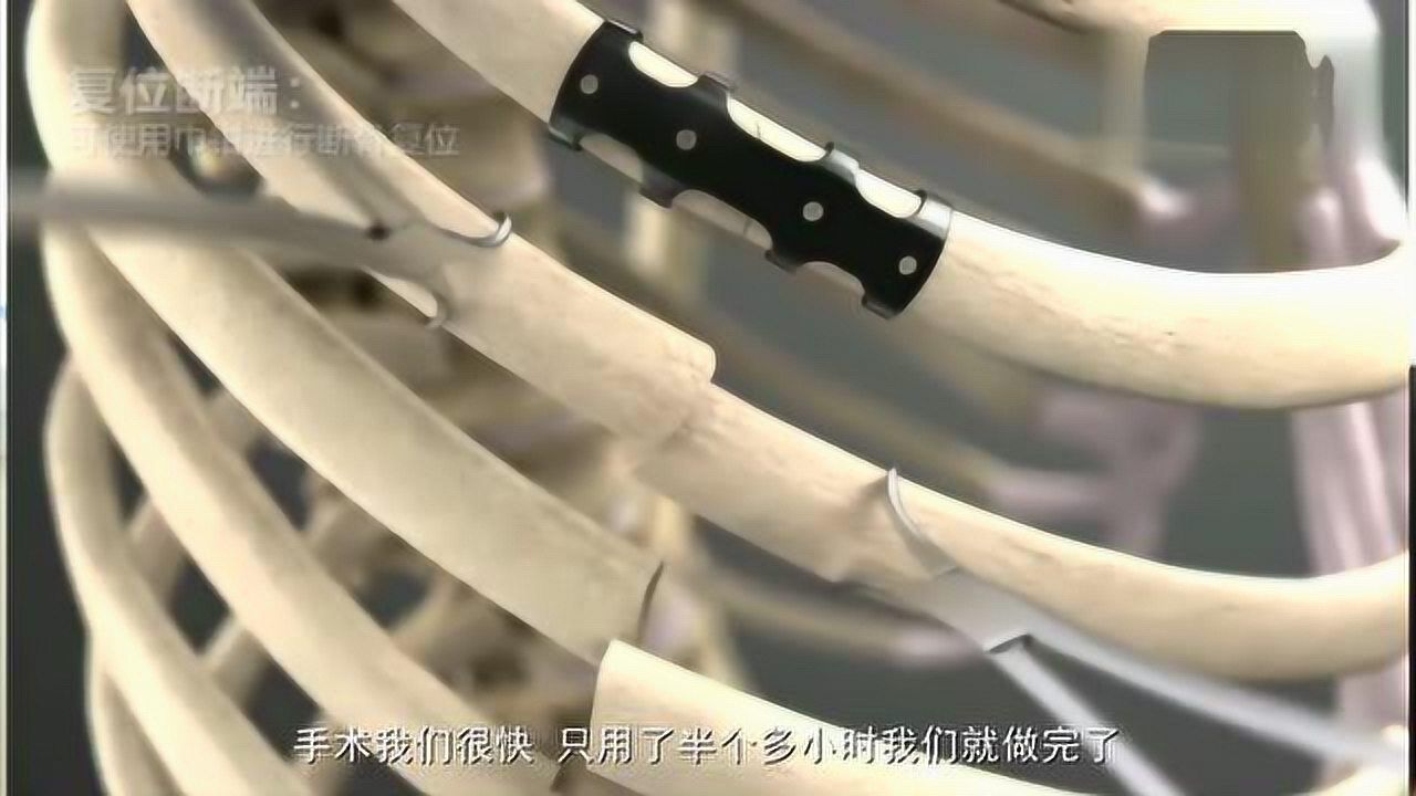 肋骨骨折切开复位内固定术