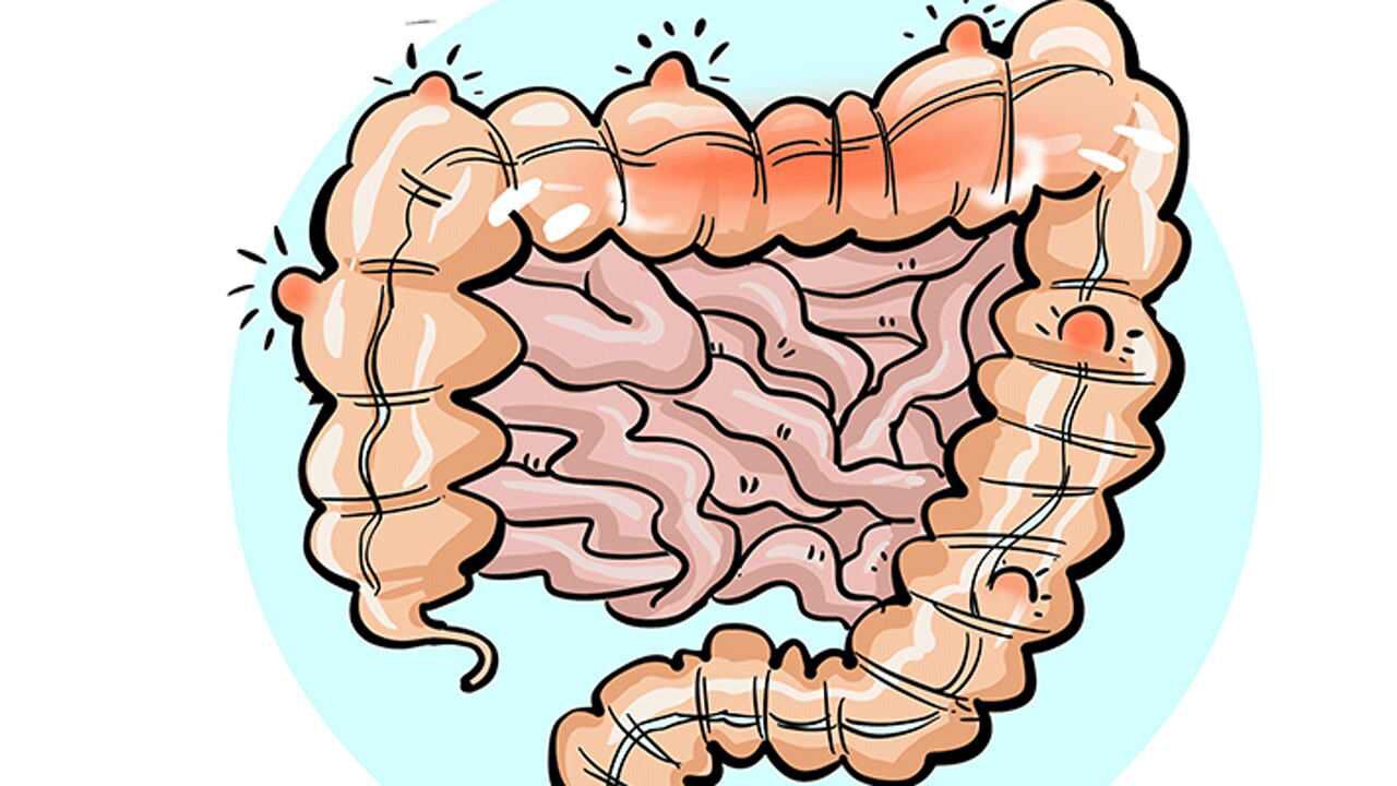 溃疡性结肠炎的治疗方法