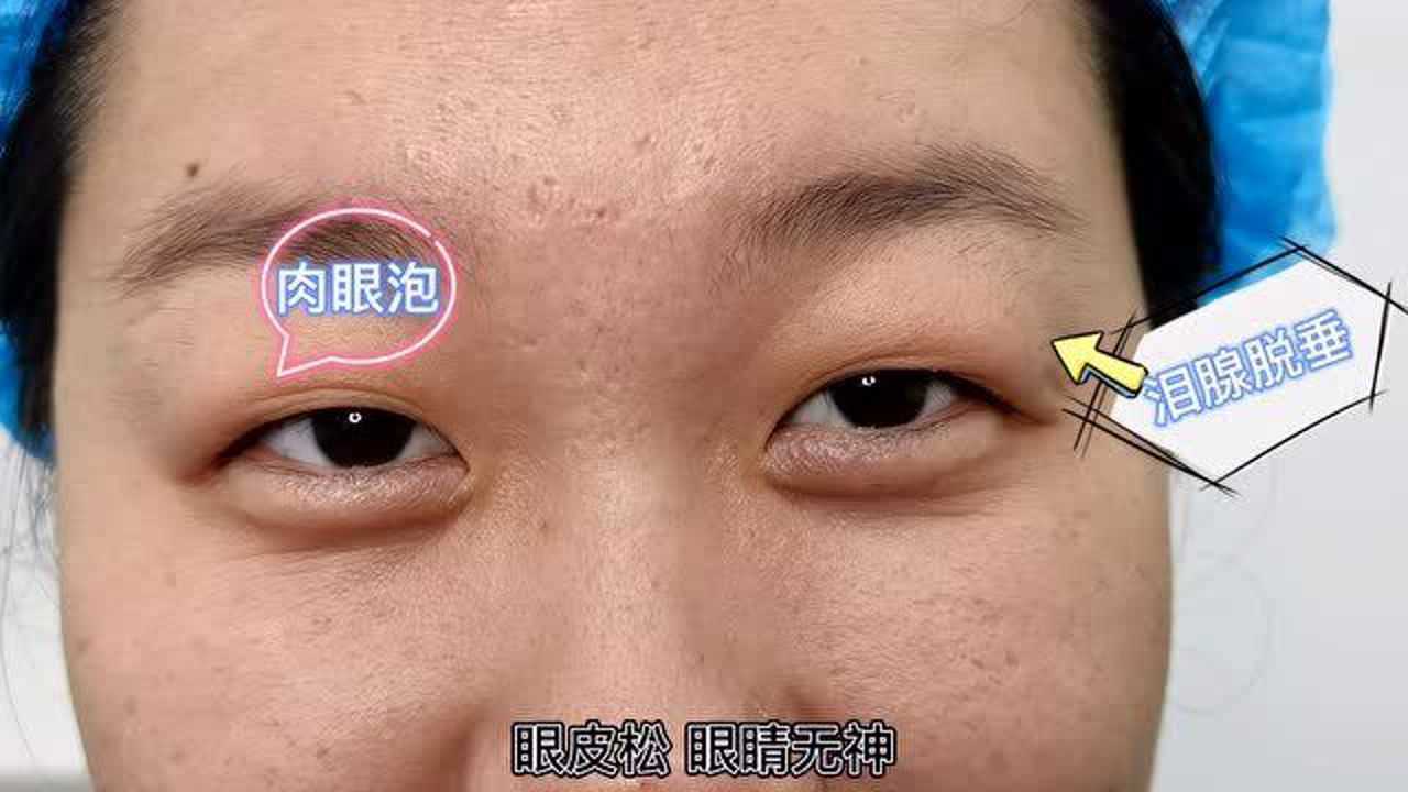 雙眼皮加淚腺脫垂復位