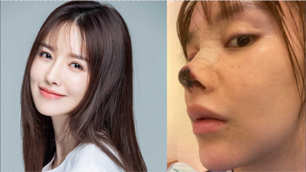 演员高溜整形致鼻坏死:涉事医美机构被罚4.9万 医生被暂停执业半年
