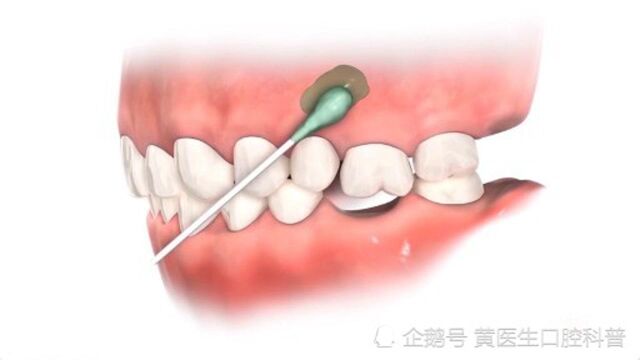 令人闻风丧胆的打骨钉,是如何矫正你的牙齿的.