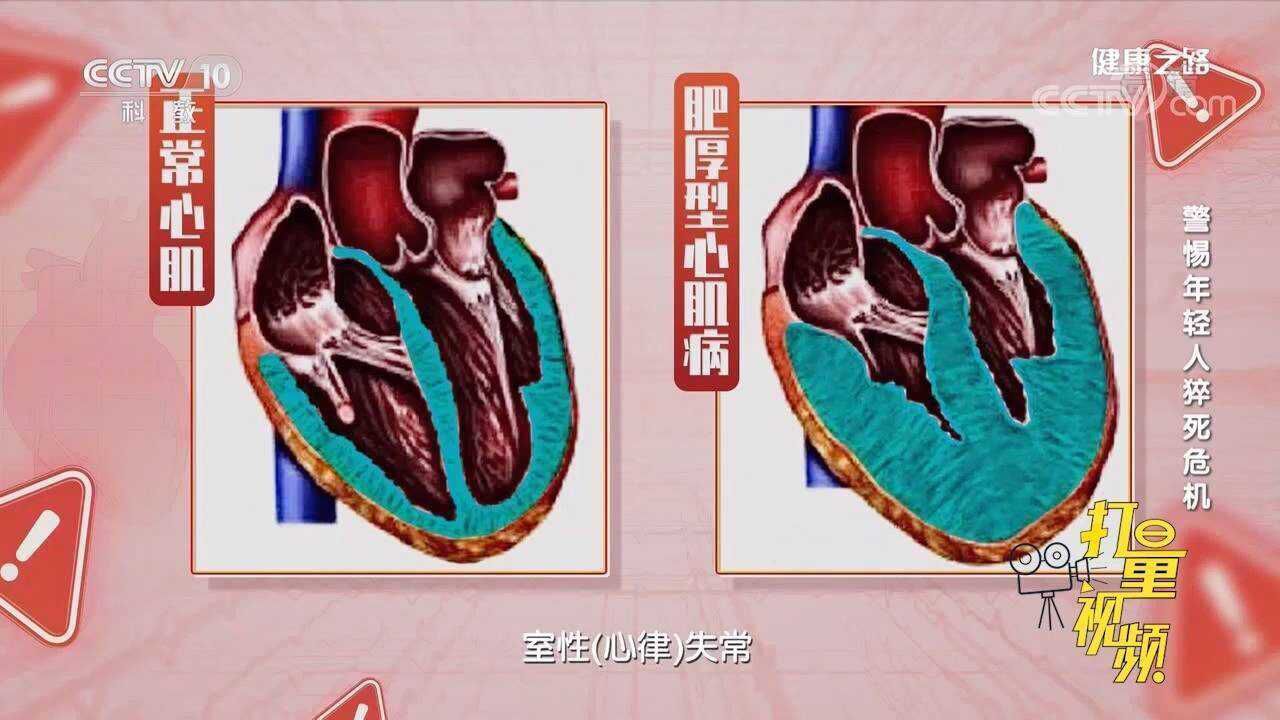 室颤为何会致猝死?一段动画演示,黄金抢救时间很重要_腾讯视频