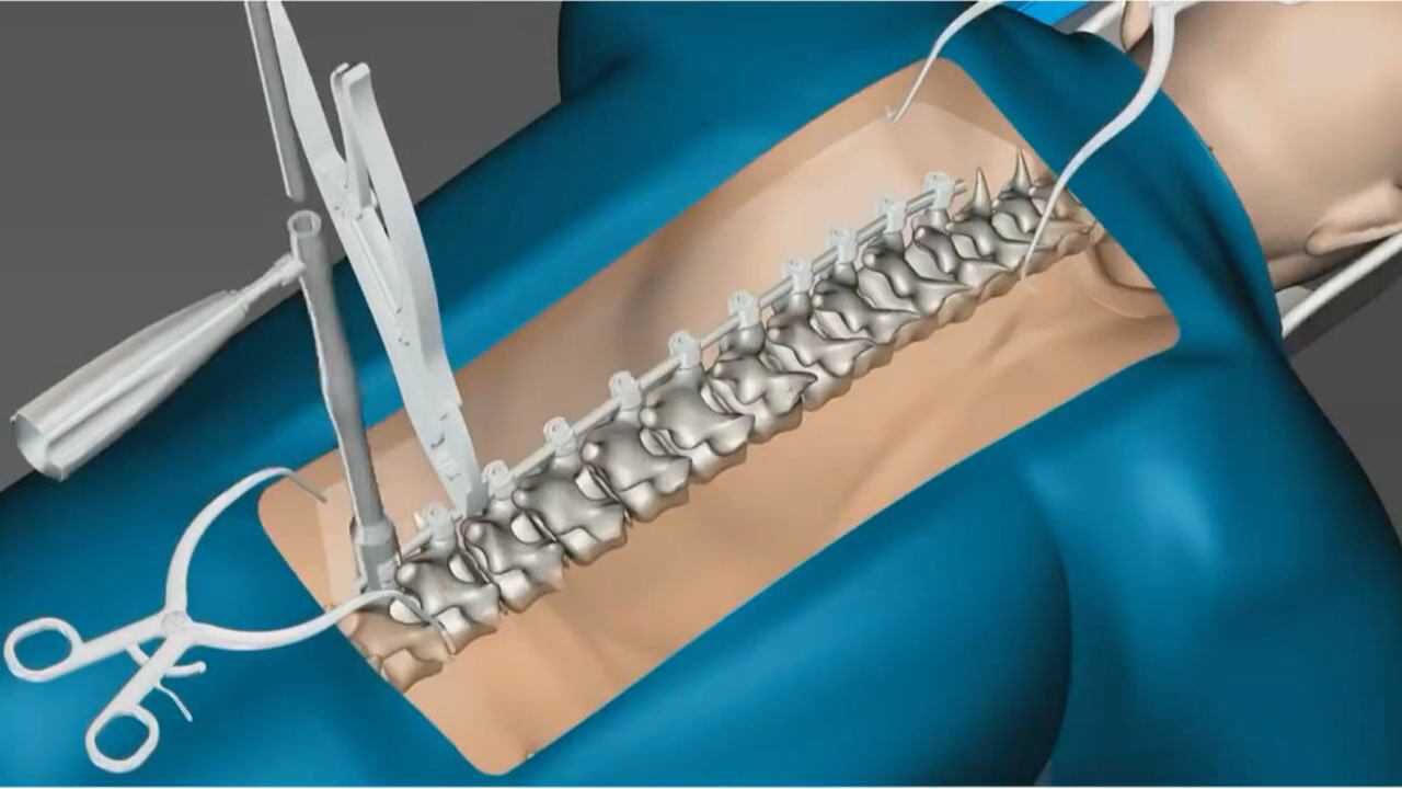 腰间盘突出打钢钉可以撑几年原来是这样