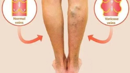 血栓是拖出来的？腿脚出现3种信号，是血管堵塞症状，不能拖