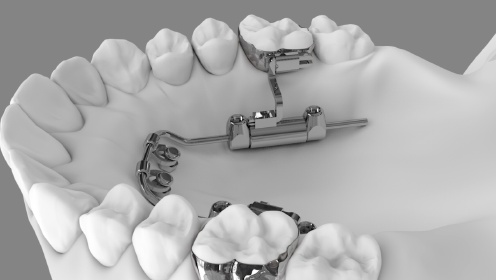 腭侧磨牙远移装置compliance-free treatment (advanced molar distalization appliance)