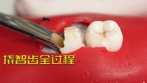 拔智齿的时候，能听到嘎嘣脆的声音是一种什么体验#好片征集令