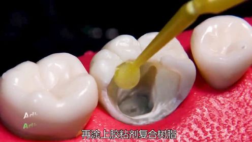 不刷牙会有什么后果 牙齿变得腐烂 修复补牙全过程