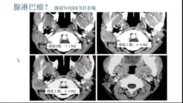 腮腺肿瘤影像学技术优化选择广西医科大学附属肿瘤医院苏丹柯